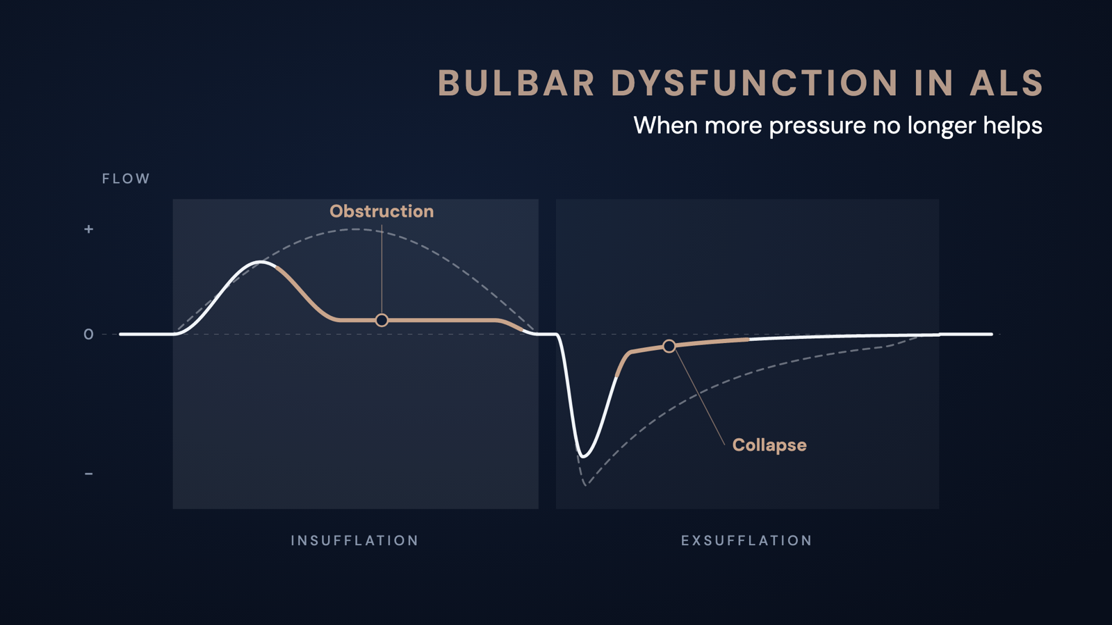Schematic flow curve of mechanical insufflation-exsufflation: with bulbar dysfunction the flow flattens early during insufflation and collapses after the peak during exsufflation, compared with the dashed normal course.