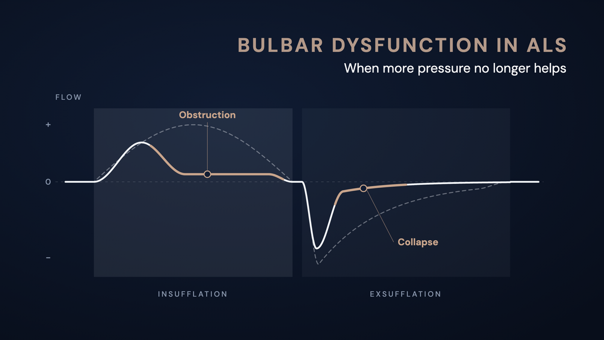Schematic flow curve of mechanical insufflation-exsufflation: with bulbar dysfunction the flow flattens early during insufflation and collapses after the peak during exsufflation, compared with the dashed normal course.