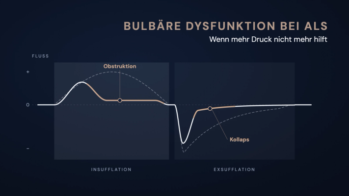 Schematische Flusskurve einer mechanischen Insufflation-Exsufflation: Bei bulbärer Dysfunktion flacht der Fluss in der Insufflation früh ab und bricht in der Exsufflation nach der Spitze ein, verglichen mit dem gestrichelten Normalverlauf.