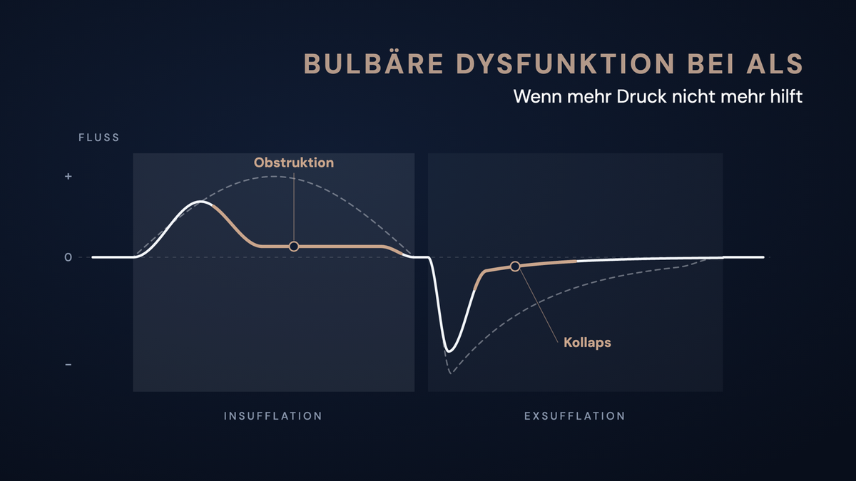 Schematische Flusskurve einer mechanischen Insufflation-Exsufflation: Bei bulbärer Dysfunktion flacht der Fluss in der Insufflation früh ab und bricht in der Exsufflation nach der Spitze ein, verglichen mit dem gestrichelten Normalverlauf.
