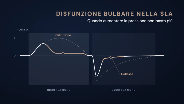 Curva di flusso schematica di un'insufflazione-essufflazione meccanica: in presenza di disfunzione bulbare il flusso si appiattisce presto durante l'insufflazione e crolla dopo il picco durante l'essufflazione, rispetto all'andamento normale tratteggiato.