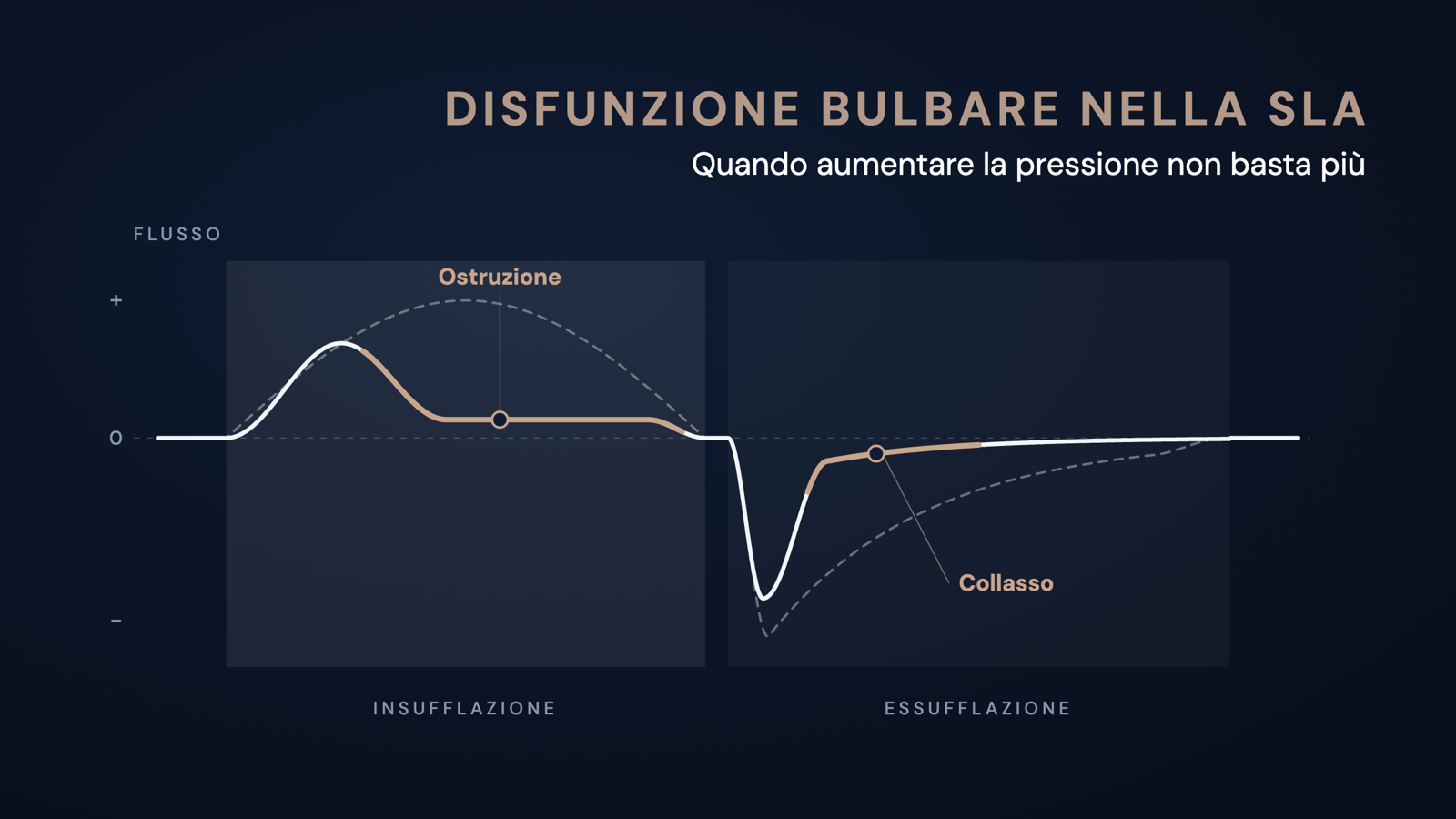 Curva di flusso schematica di un'insufflazione-essufflazione meccanica: in presenza di disfunzione bulbare il flusso si appiattisce presto durante l'insufflazione e crolla dopo il picco durante l'essufflazione, rispetto all'andamento normale tratteggiato.