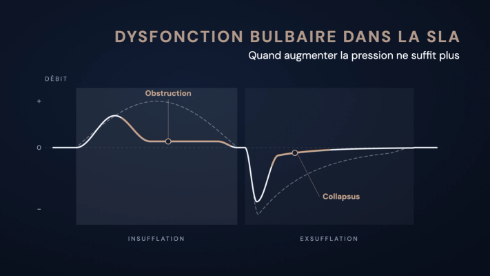 Courbe de débit schématique d'une insufflation-exsufflation mécanique : en cas de dysfonction bulbaire, le débit s'aplatit tôt pendant l'insufflation et s'effondre après le pic pendant l'exsufflation, comparé à la courbe normale en pointillés.