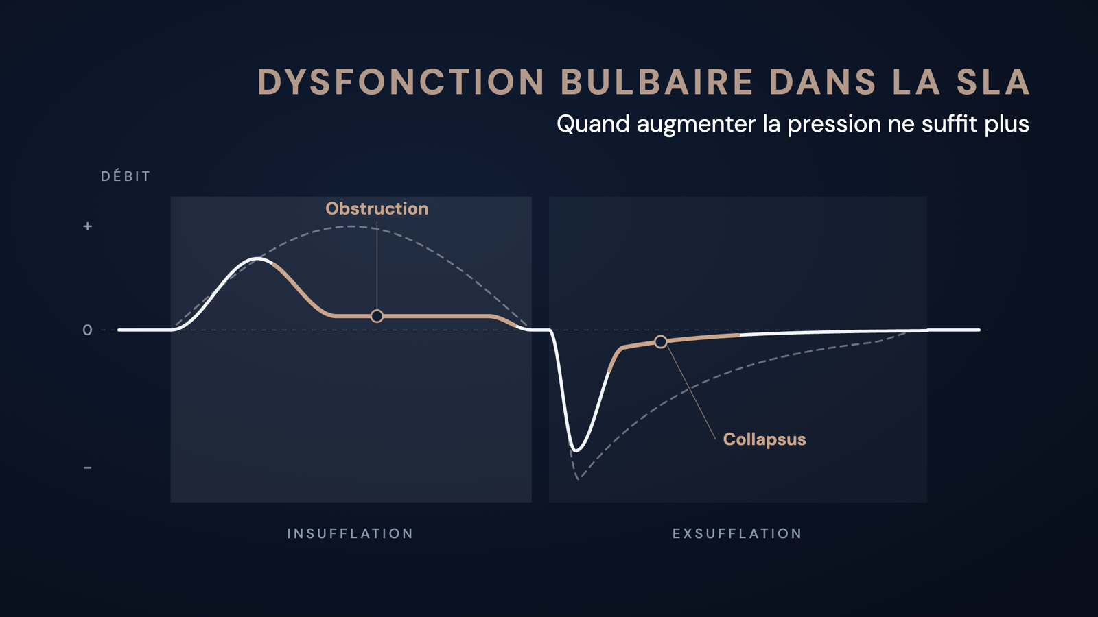Courbe de débit schématique d'une insufflation-exsufflation mécanique : en cas de dysfonction bulbaire, le débit s'aplatit tôt pendant l'insufflation et s'effondre après le pic pendant l'exsufflation, comparé à la courbe normale en pointillés.