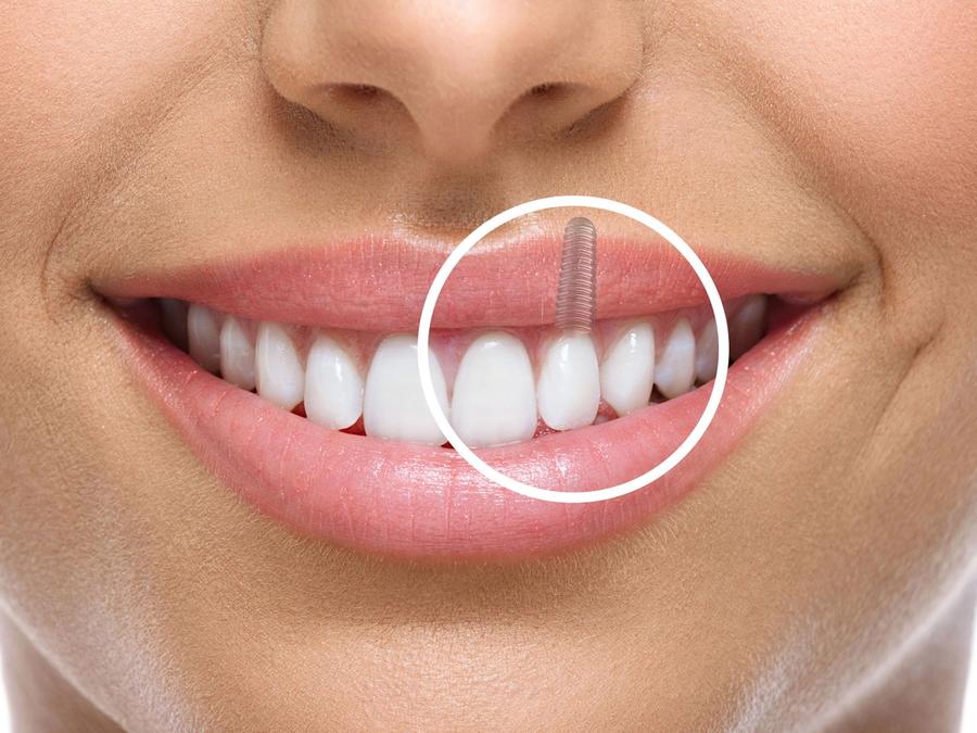 Dental Implants