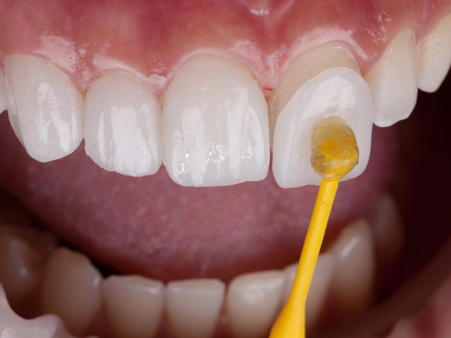 Veneers & Smile Makeovers