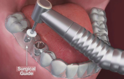 Guided Implant Surgery