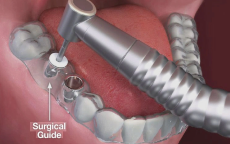 Guided Implant Surgery