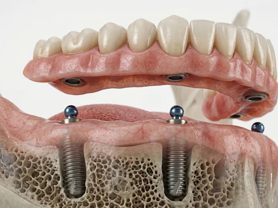 Overdenture