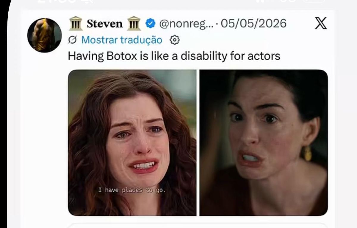 Botox virou problema para atores? Atriz Anne Hathaway viraliza por suposto uso excessivo de método em filme Odisseia
