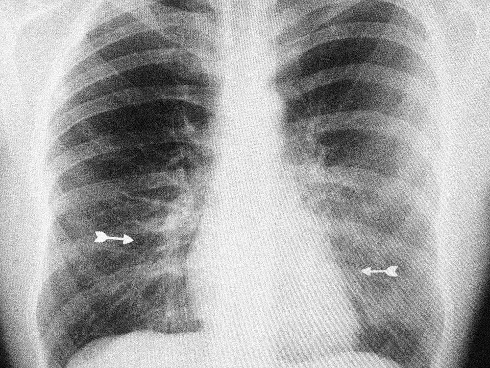 An x-ray of a human's ribs, two miniature arrows such as those that would be shot from a bow can also be seen.