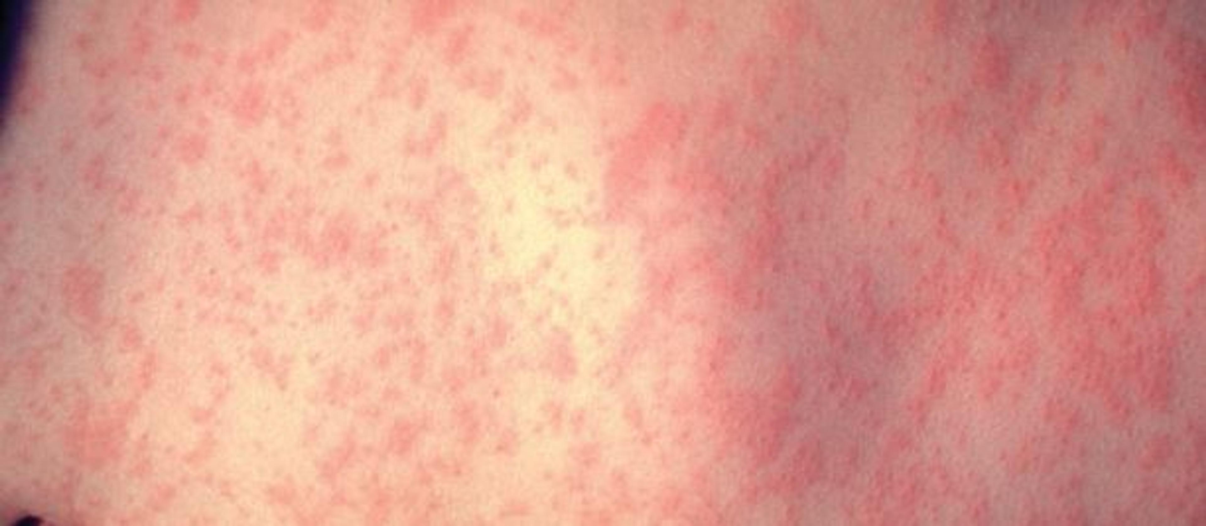 Doctors are urging parents to vaccinate their children against measles after a case was discovered in Northland. 