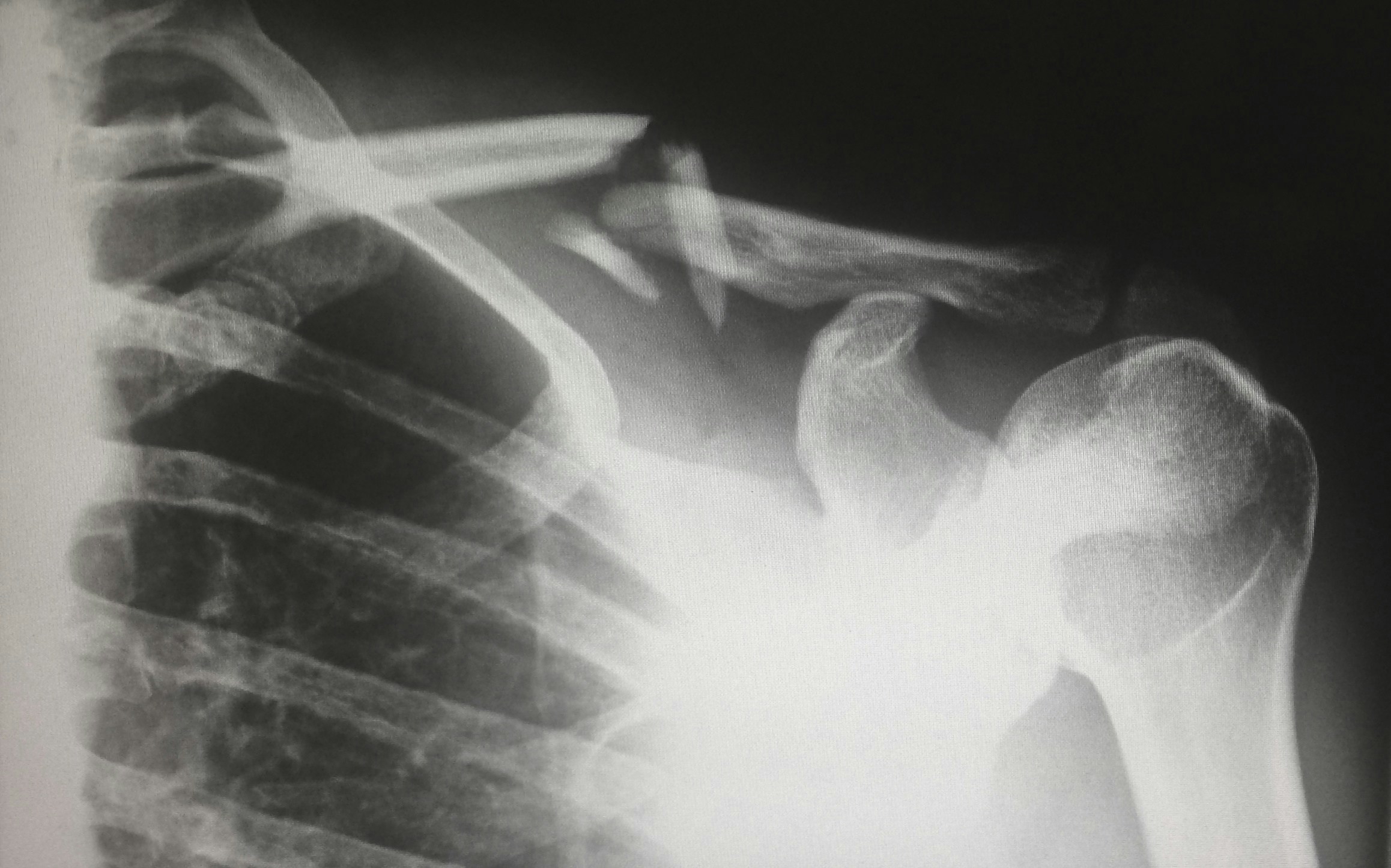 Image X-ray showing a severe displaced clavicle fracture near the shoulder after a traumatic injury, often seen in personal injury cases