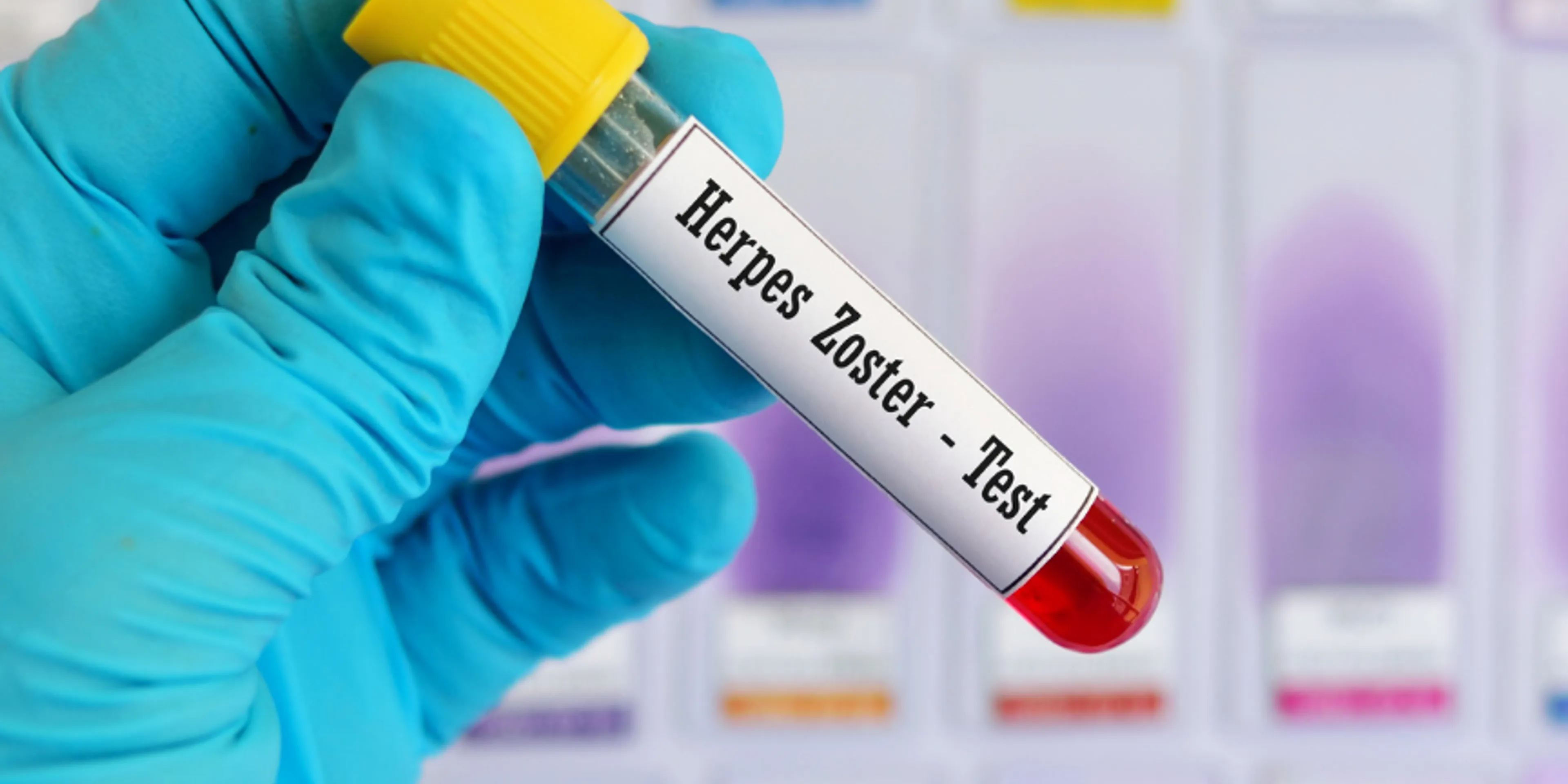 En Soy Más, el Dr. Francisco Moreno explica todo sobre el herpes zóster