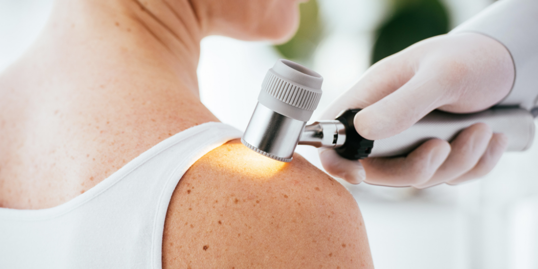 melanoma, cáncer de piel