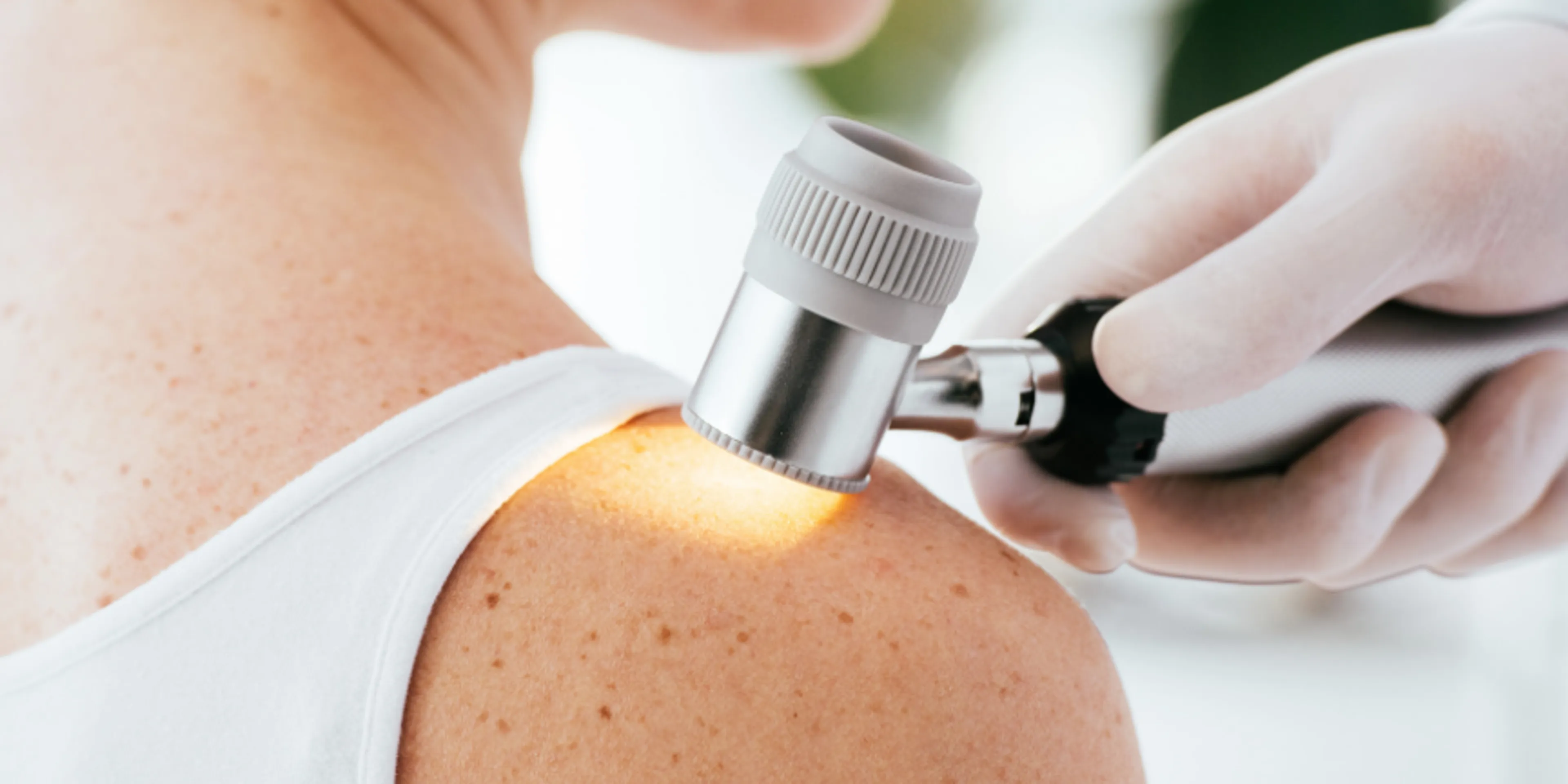 melanoma, cáncer de piel