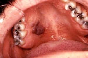 Oral cancer awareness — minimize your risk