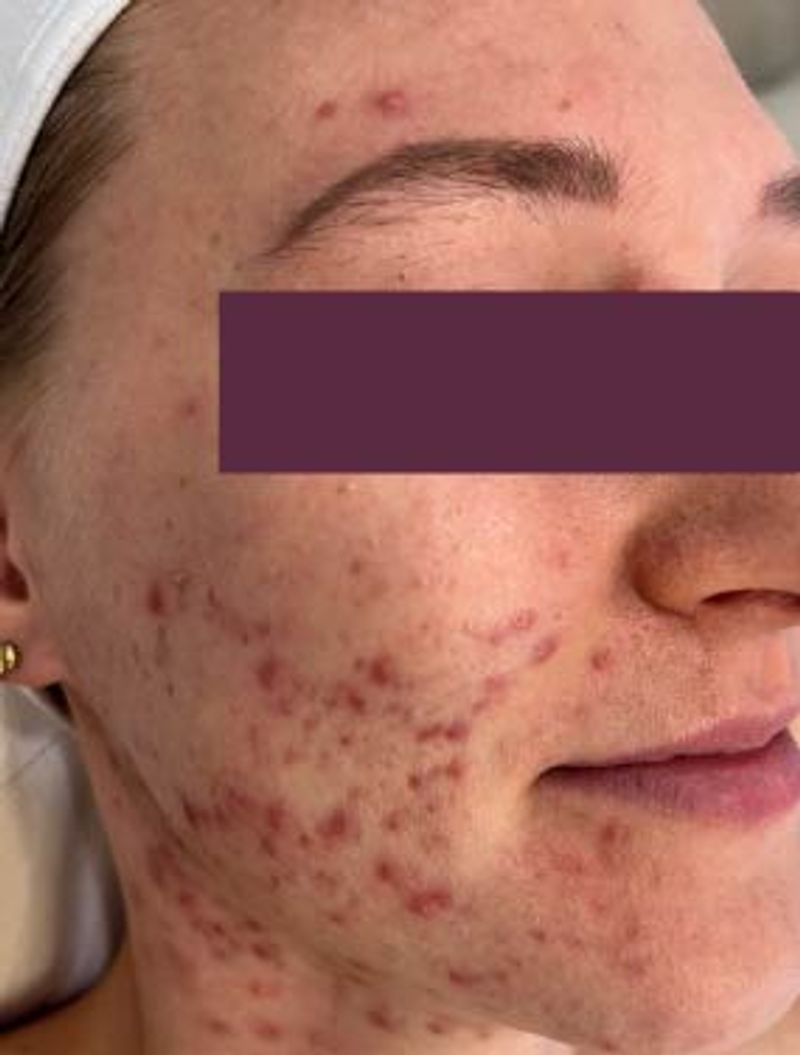 woman with acne 