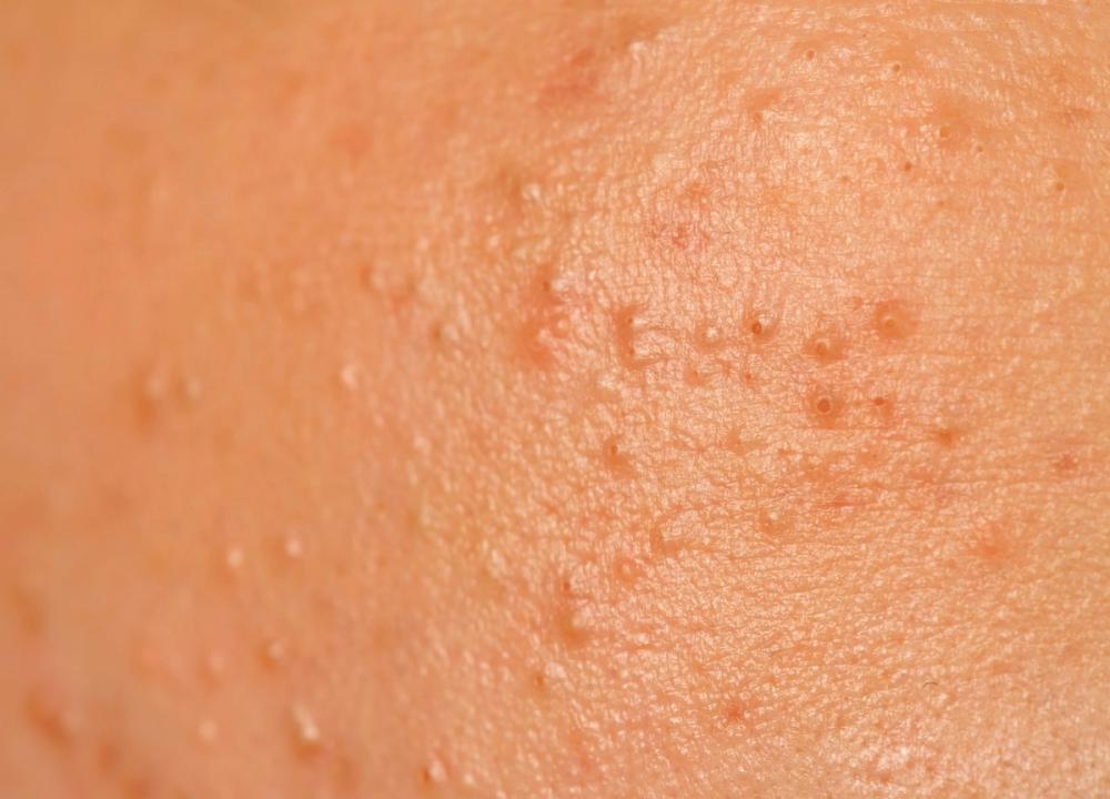 close up of acne on a face
