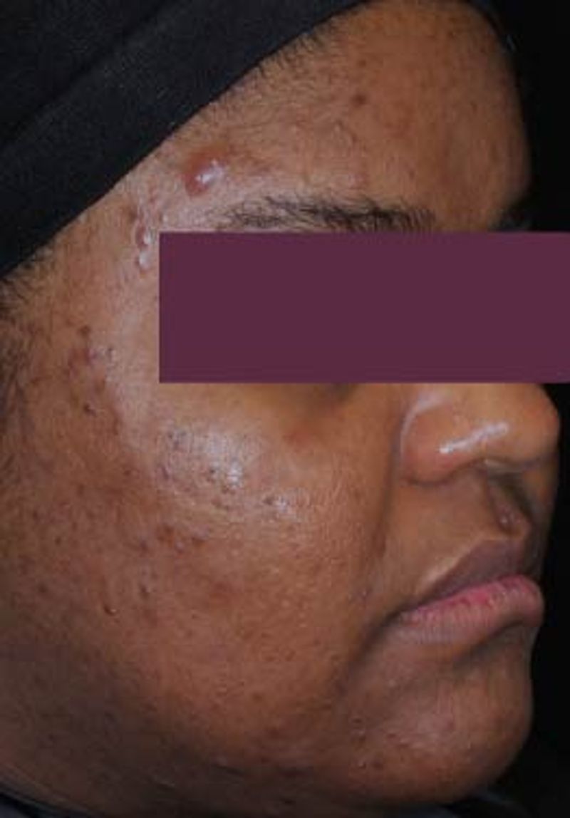 woman with less acne