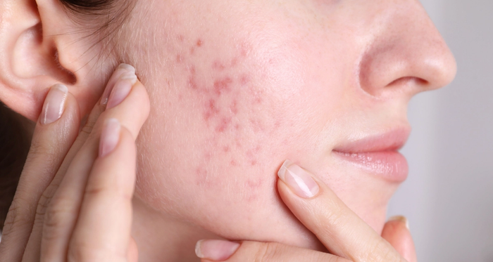 close-up of a woman's acne scars