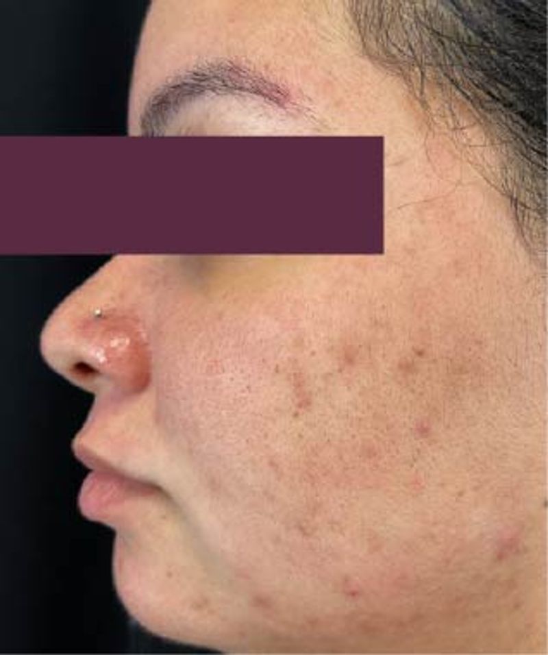 woman with acne 