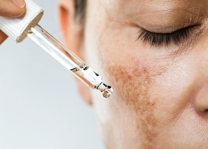 woman putting serum on hyperpigmentation