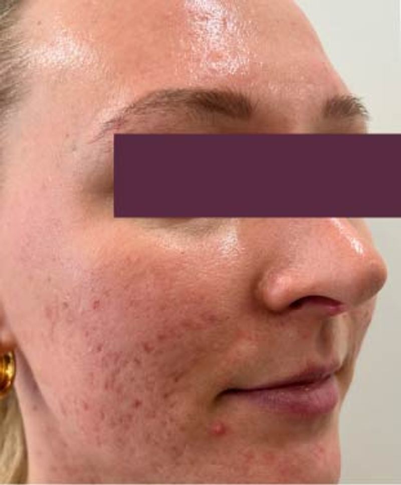 woman with less acne