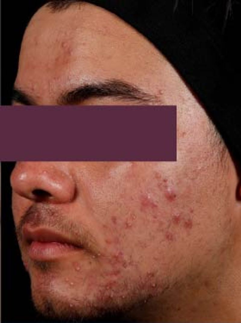 man with cystic acne