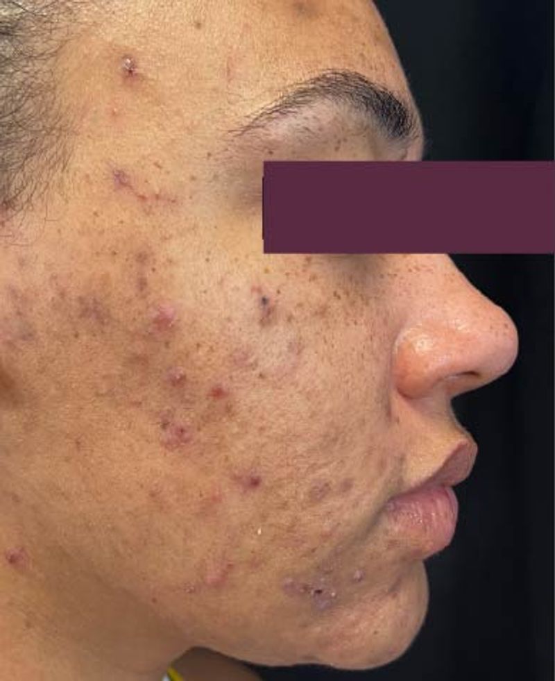 woman with acne 