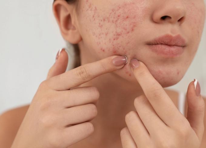 woman popping a zit