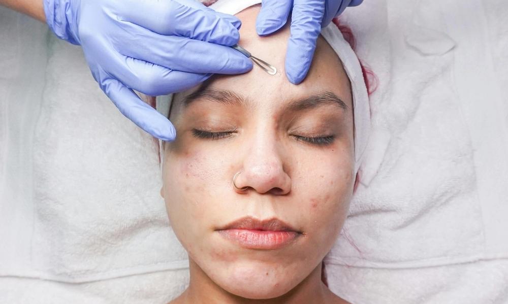 a woman having extractions on her forehead