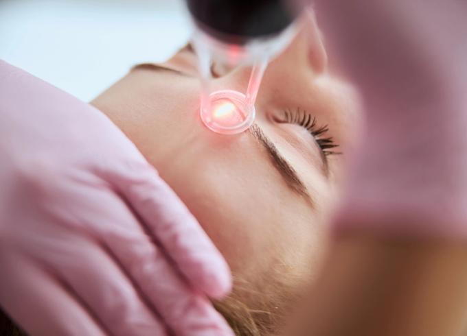 woman receiving laser treatment on her face