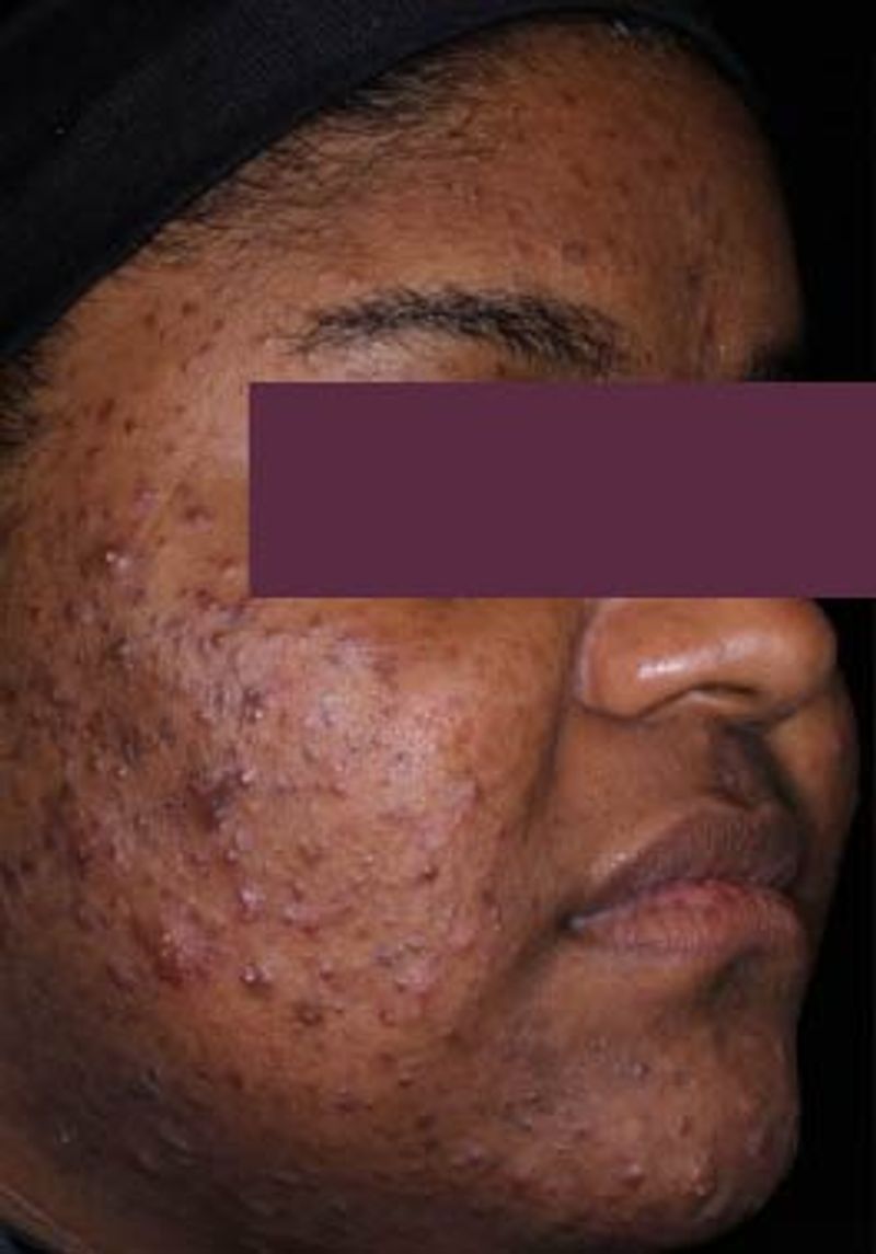 woman with acne 