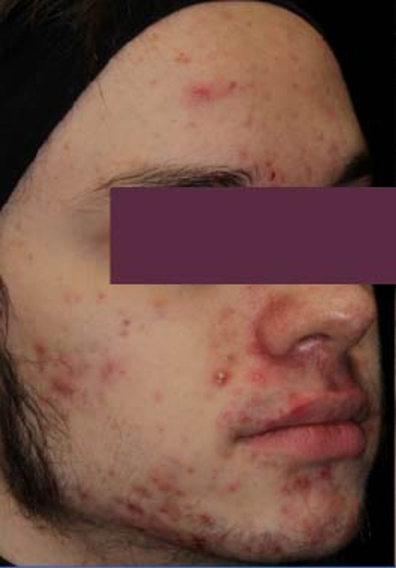 man with cystic acne