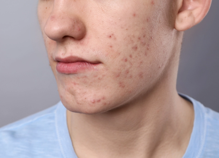 closeup of a man's acne