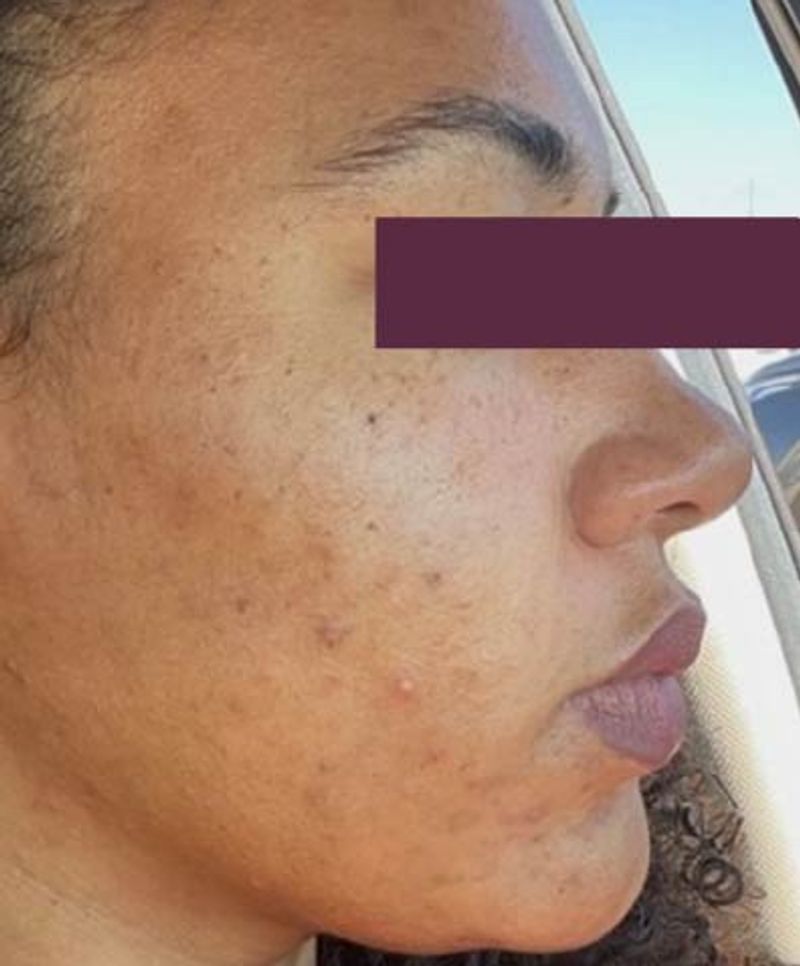 woman with less acne