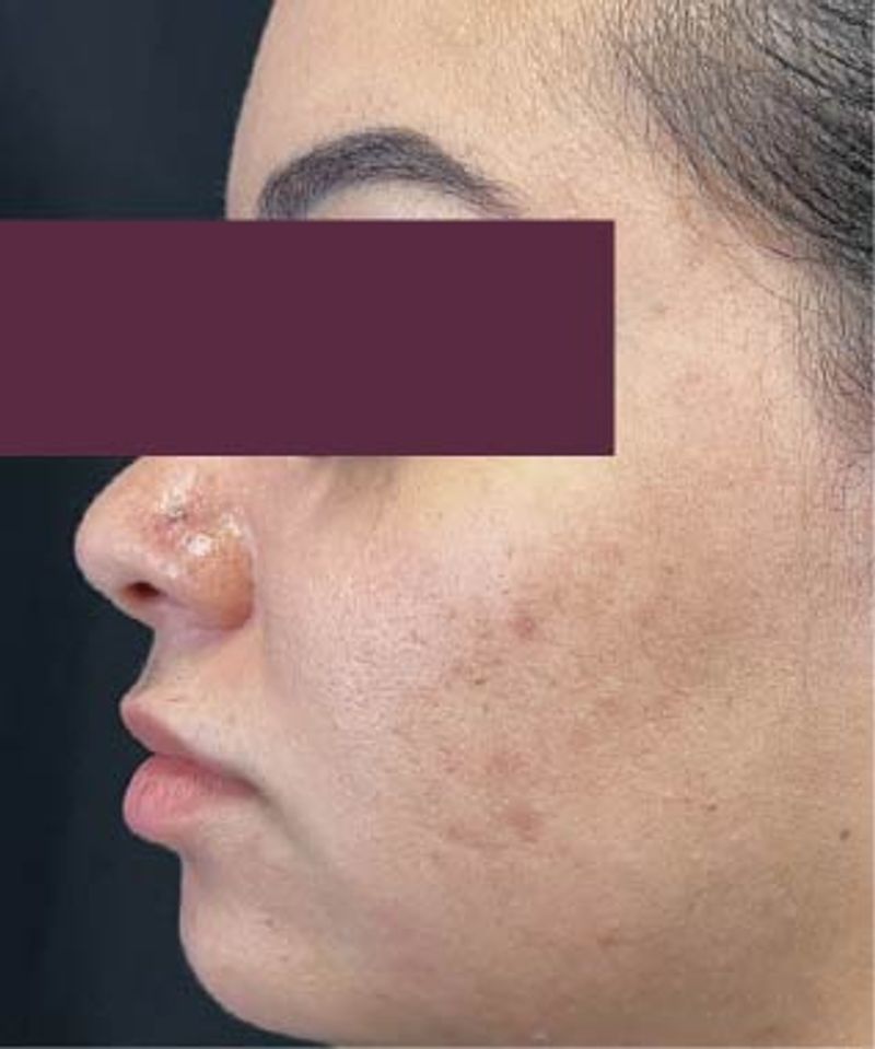 woman with less acne