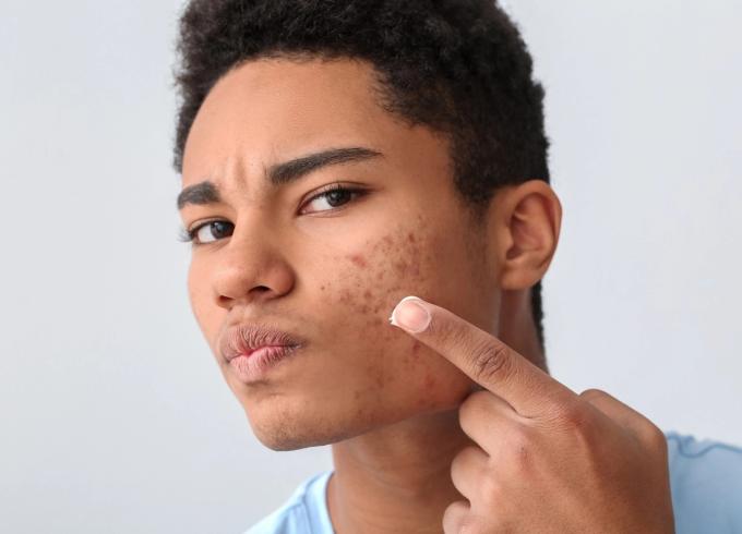 young man pointing at acne on his face