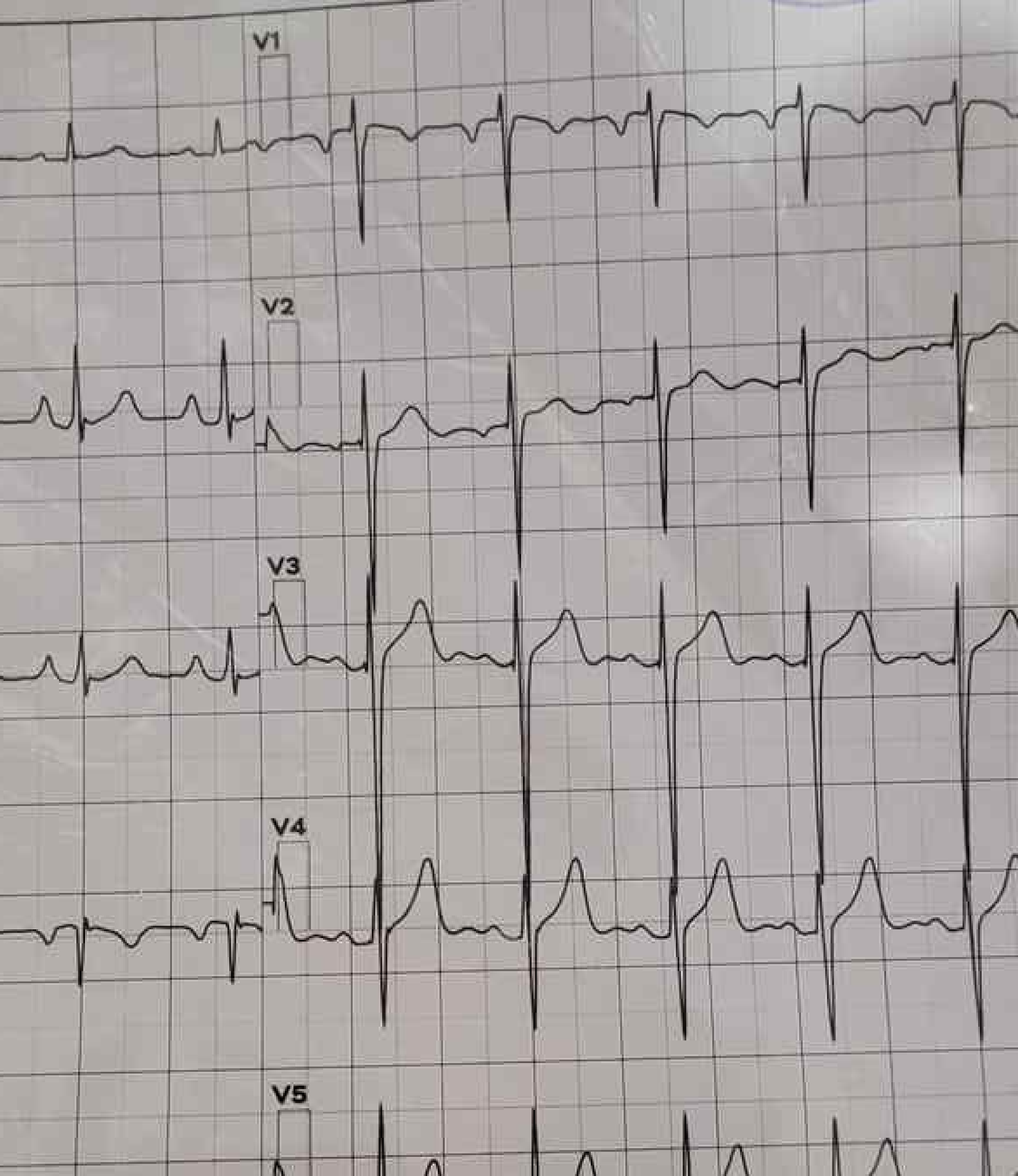 Cardiogram printed on a paper