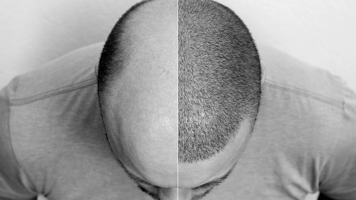 So what actually goes into a hair transplant?