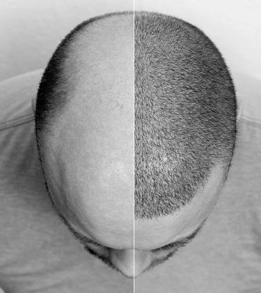 So what actually goes into a hair transplant?
