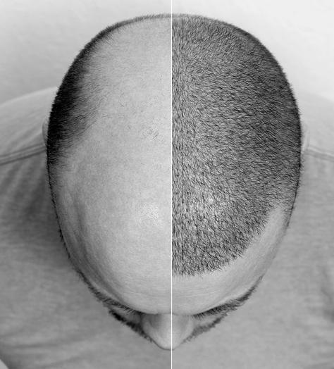 So what actually goes into a hair transplant?