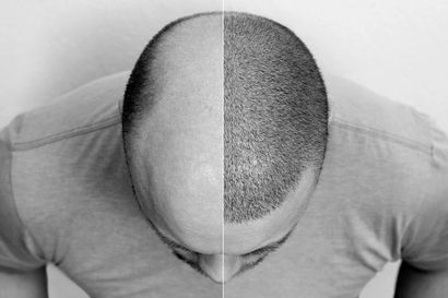 So what actually goes into a hair transplant?