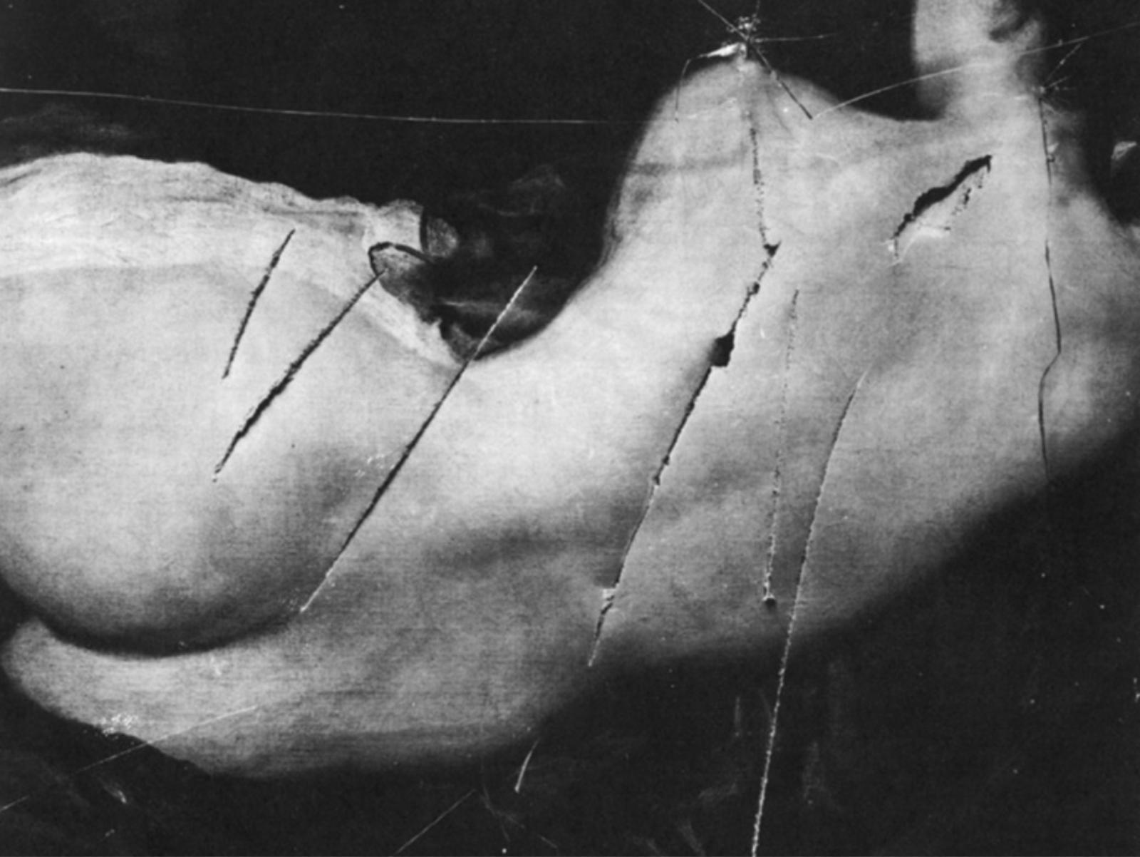 Damage done to Robuky’s Venus (c. 1647-1651) by Suffagrettes in 1914. Courtesy of National Portrait Gallery.