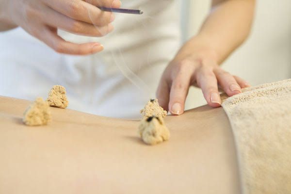 Moxabehandlung mit mehreren Moxakegeln auf der Haut.