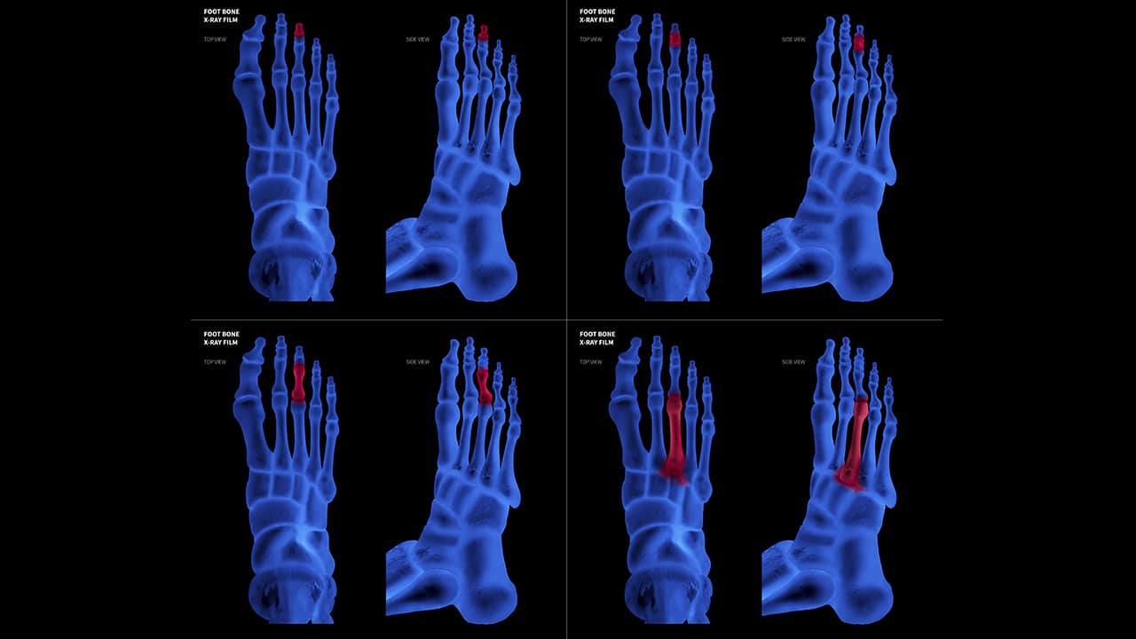 Fractura por estrés Qué es, causas, tratamiento y prevención