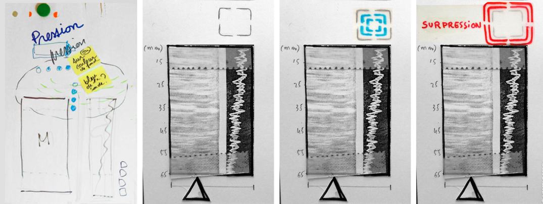 Storyboard design d'interface fibroscan