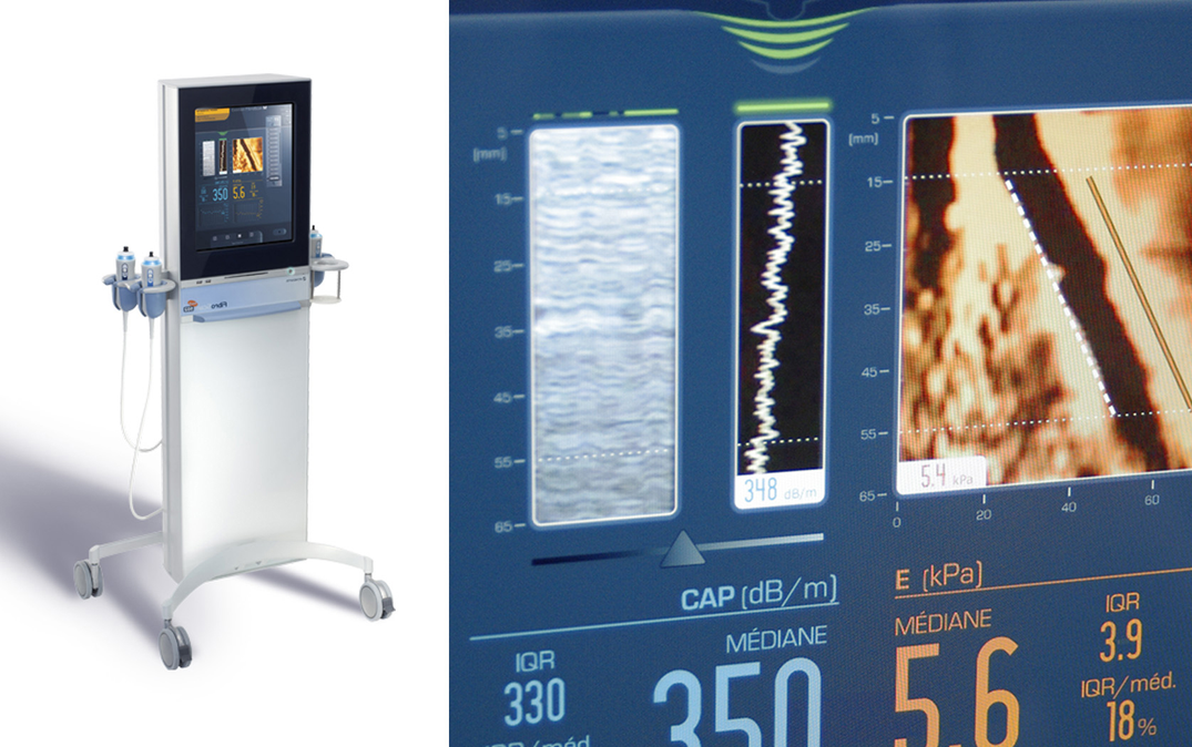 Le produit Fibroscan et son interface médicale tactile