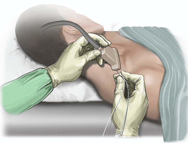 Nerve block With Ultrasound Guidance
